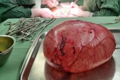 خارج کردن توده ۱۵ کیلویی از بدن یک خانم قمی